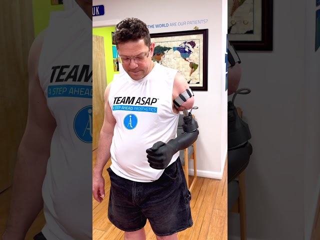 Above-Elbow Osseointegration With a Myoelectric Hand & Elbow | Mike