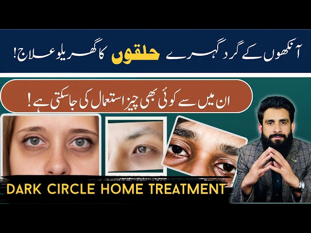 Treat Dark Circle of Eyes at Home