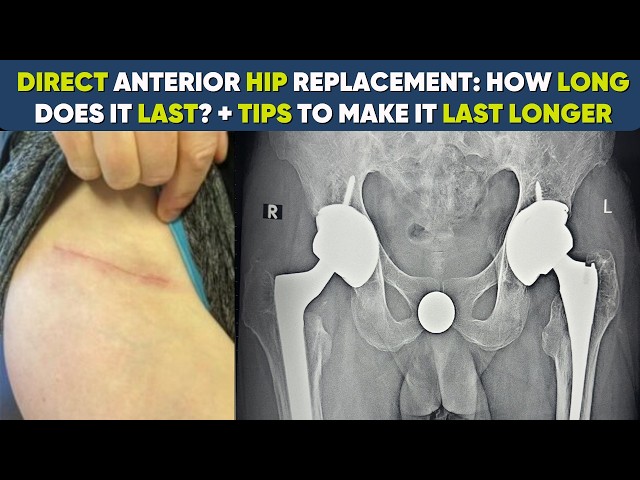 Hip Replacement won’t last forever but How to make it last longer  ? #totalhipreplacement 