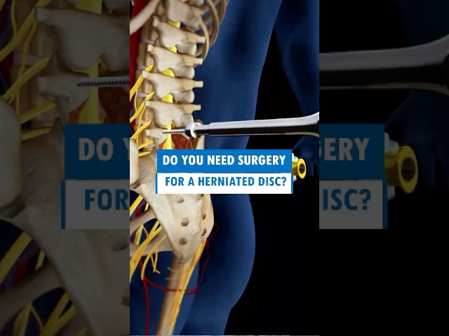 Do You Need Surgery for a #HerniatedDisc #shorts