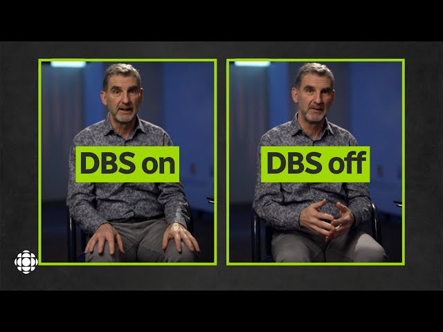 Watch how a device in his chest helps manage his Parkinson’s disease