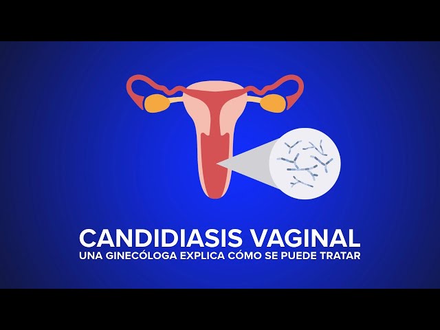 Candidiasis Vaginal - Una ginecóloga explica cómo se puede tratar | UC Davis Health