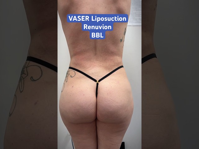 360 VASER Lipo + Renuvion + BBL = Hourglass 🔥 - Dr. Amir Arsalan | West End Plastic Surgery