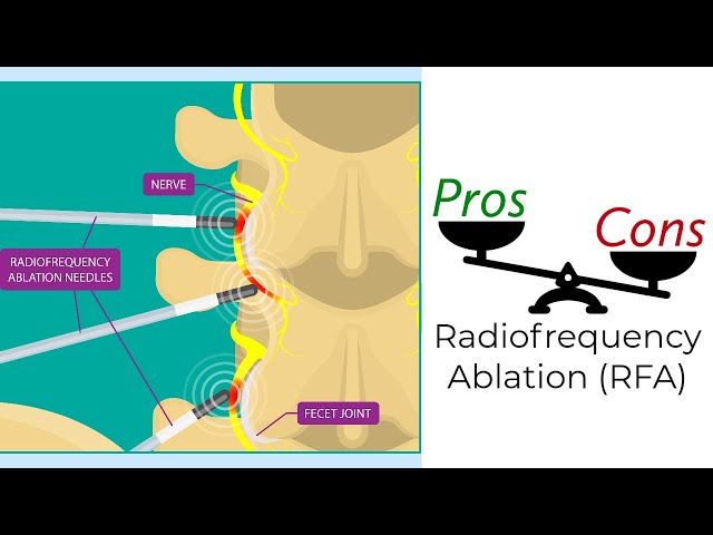 Radiofrequency Ablation - Pros & Cons