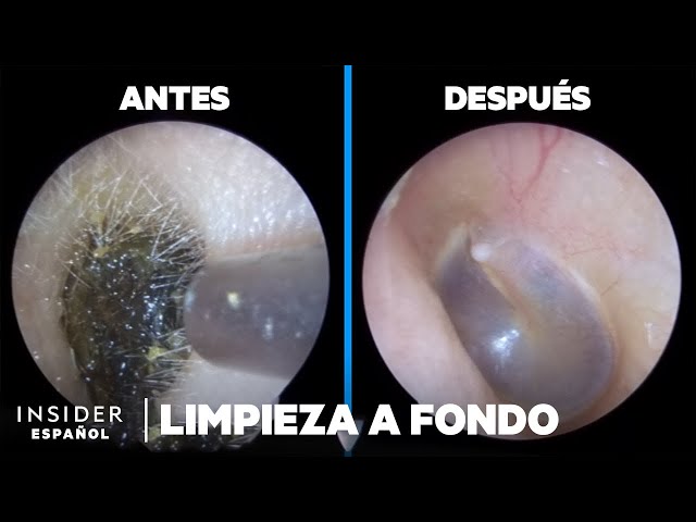 Cómo se limpia a fondo el cerumen profesionalmente | Limpieza a fondo