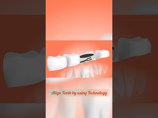 Align Tooth easily using by technology...