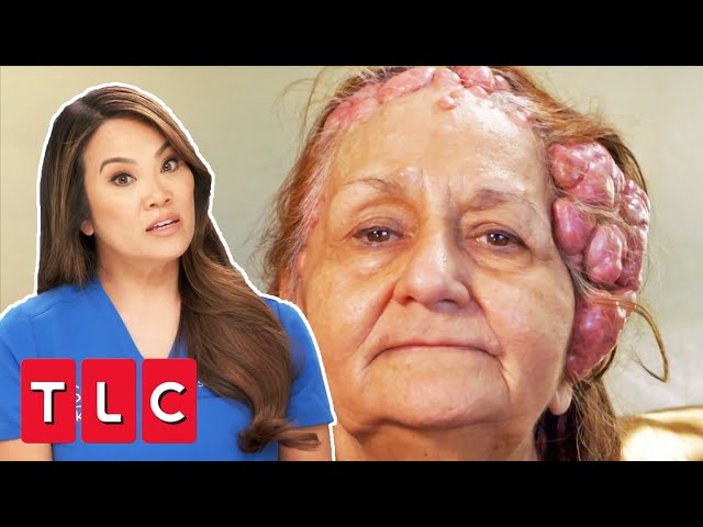 Woman Has Over 100 Cysts On Her Head | Dr Pimple Popper This Is Zit