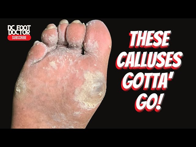 These Calluses Gotta' Go!
