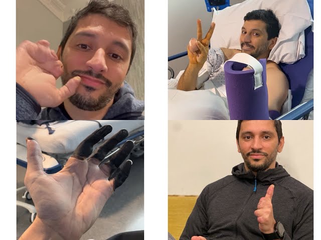 ‏بتر أصابع المغامر فهد بادار بعد إصابته بقضمة الصقيع أثناء تسلقه جبل برود بيك - غانم المفتاح