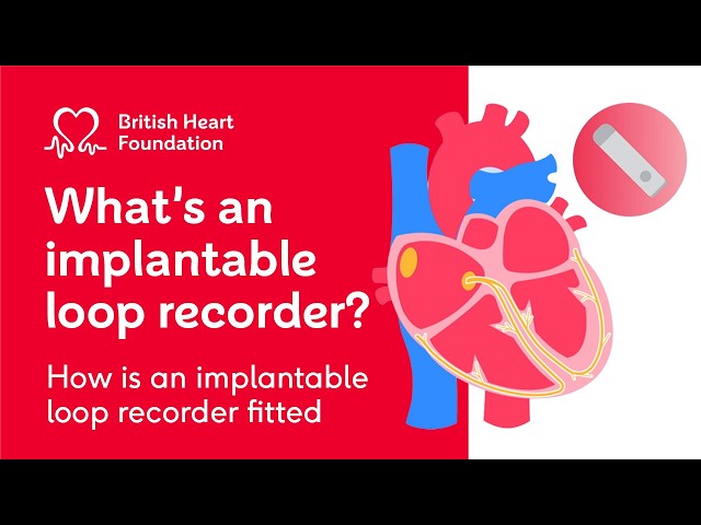 What is an implantable loop recorder?