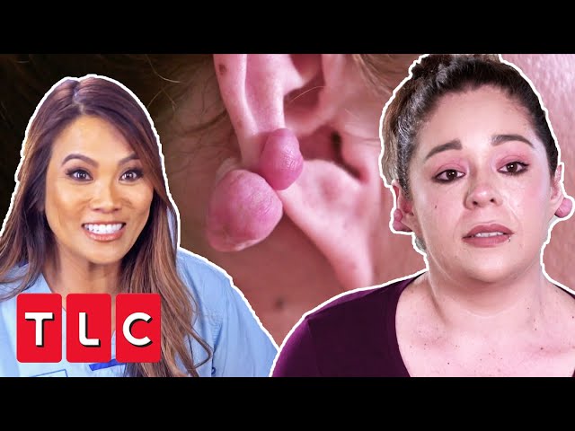 Dr Lee Helps Woman Remove Keloids That Have Been Holding Her Back | Dr Pimple Popper Pop Up