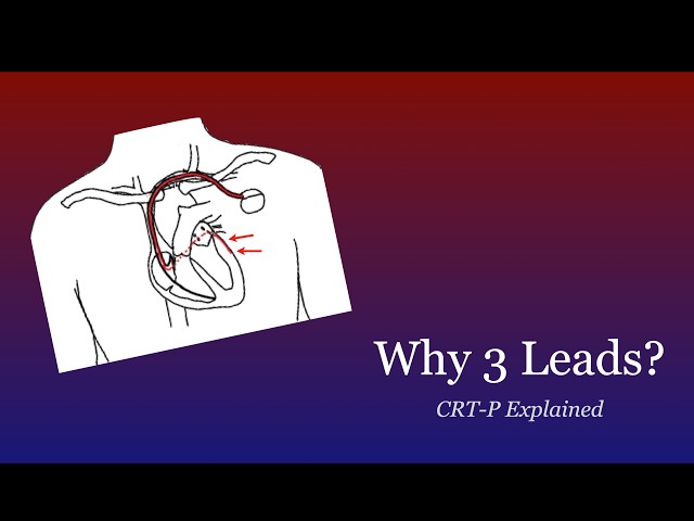 Cardiac Resynchronization Therapy (CRT-P) Explained | Why Does a Pacemaker Need 3 Leads?