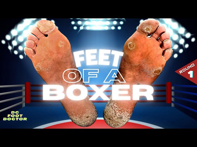 Feet of a Boxer: Knocking Out Painful Calluses, Round 1: Toes & Forefoot