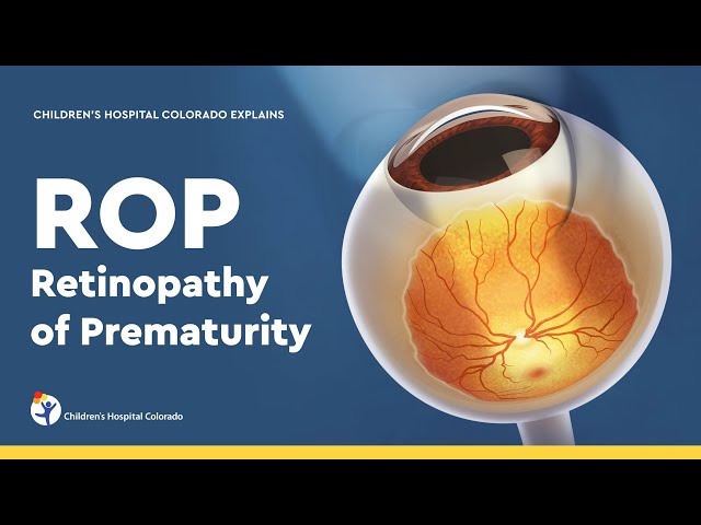 Retinopathy of Prematurity: Diagnosis and Treatment