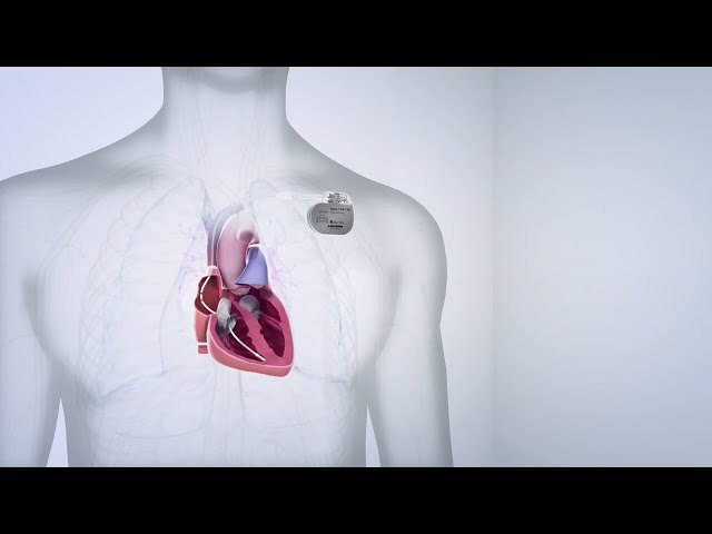 ICD Implantation