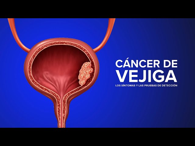 Cáncer de vejiga - Los síntomas y las pruebas de detección |  UC Davis Health