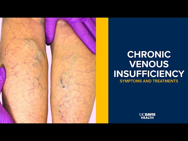Chronic Venous Insufficiency (CVI) - Symptoms, Causes & Treatments Explained | UC Davis Health