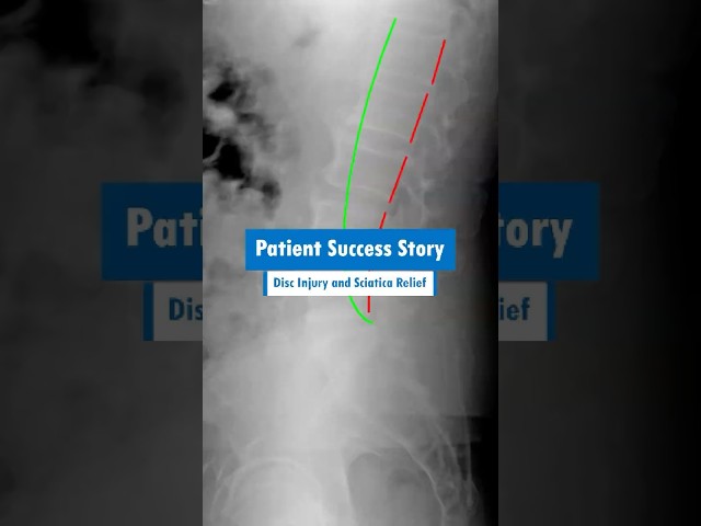 Fast Sciatica Relief: 90% Pain Reduction in Only 1 Month #shorts