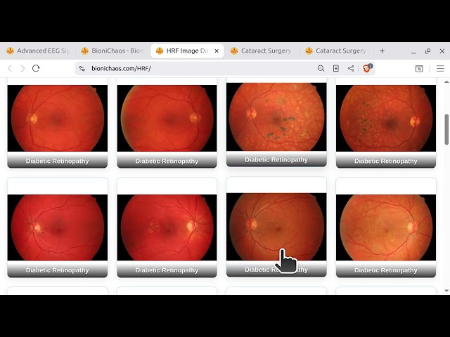AI Agent Debugs JavaScript: Fixing a Cataract Surgery Web Sim