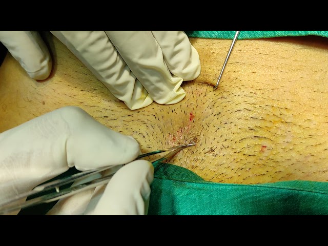 Pubic hair graft extraction for eyebrow Transplant