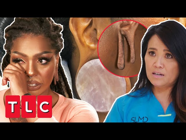 Dr Lee Restores Patient’s Overly Stretched Earlobe | Dr Pimple Popper: Pop Ups