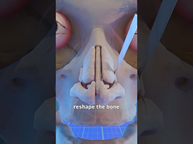 How A Nose Surgery Works 🤔