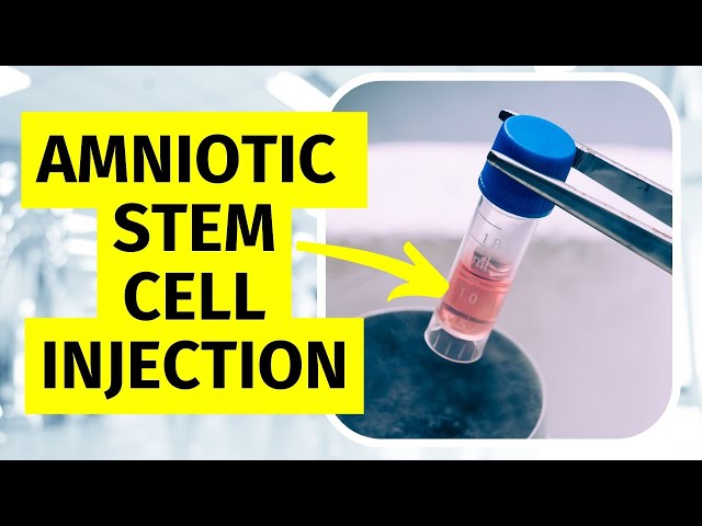 Amniotic Stem Cell Injection for Knee Arthritis