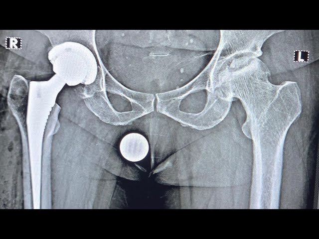 Bikini DAA Hip replacement-Live Q&A with Dr Pankaj Walecha part 2- 05.07.2026