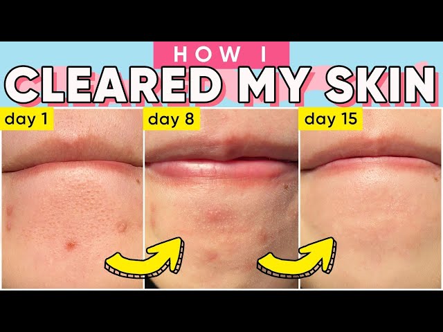 How To Minimize Large PORES, BLACKHEADS, WHITEHEADS & ACNE! 🙌