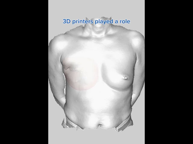 Revolutionary 3D-Customized Breast Prosthesis: Boosting Confidence After Mastectomy