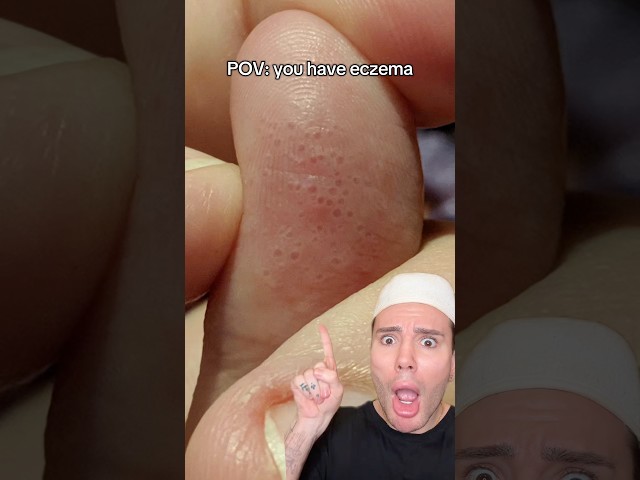 POV: you have eczema!😱 #eczema #skincareroutine #skincaretips #skincareproducts #skin