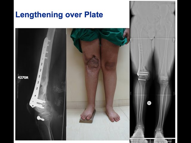 Limb Lengthening - Decision Making & Execution