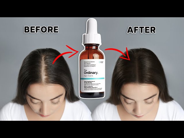 Is The Ordinary Serum Better Than Minoxidil for Hair Loss? A Hair Transplant Doctor Explains