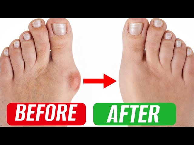 The BUMP on the BIG TOE is gone! How to easily get rid of a BUNION?