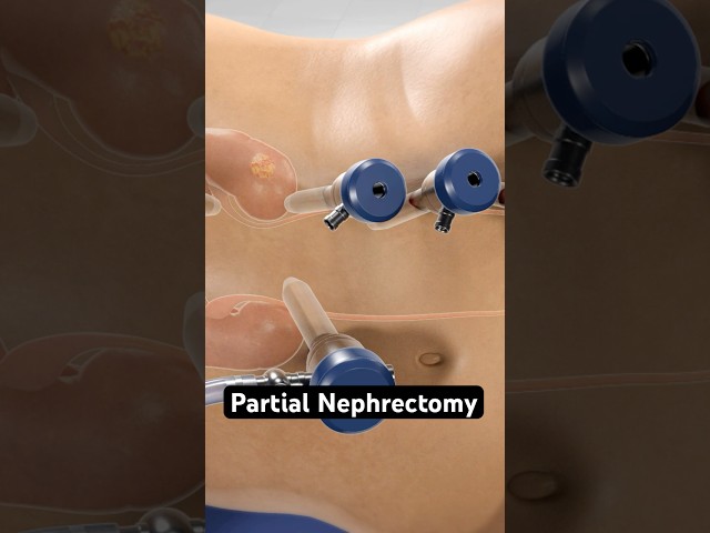 Remove a Kidney Tumor Without Losing the Kidney?