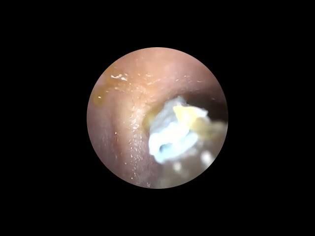 I Tried a Home Ear Wax Removal Camera… Here’s What Came Out
