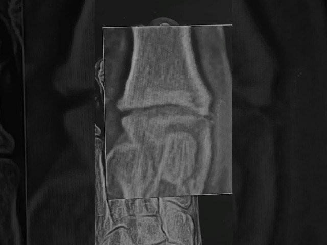 Hallux Limitus #podiatry #arthritis #halluxlimitus #bonespur #bigtoepain