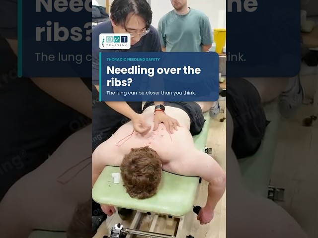 Needling over the ribs  #manualtherapy #physiotherapist #dryneedling ￼