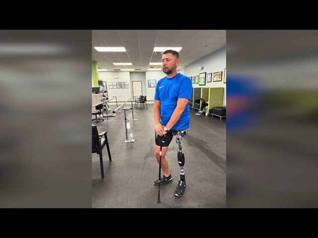 Ukrainian Soldier Hemipelvectomy Amputee Walking Unassisted