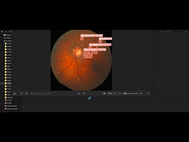 Precision Eye Care Employing YOLO V7 for the Detection of Optical Glaucoma via Python
