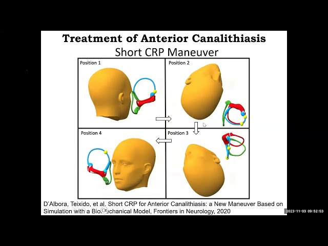 Treatment of Anterior Canal BPPV
