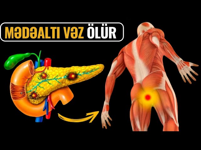 Mədəaltı Vəzin Xəstə Olduğunu Göstərən 10 ƏLAMƏT