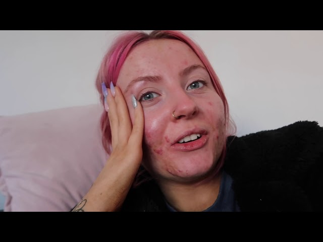 MY FIRST MONTH ON ACCUTANE // SIDE EFFECTS // ABBIE BULL