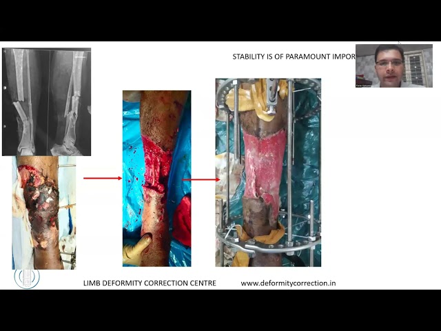 Principles of Treatment, Infected NU - Dr Purav Kansara