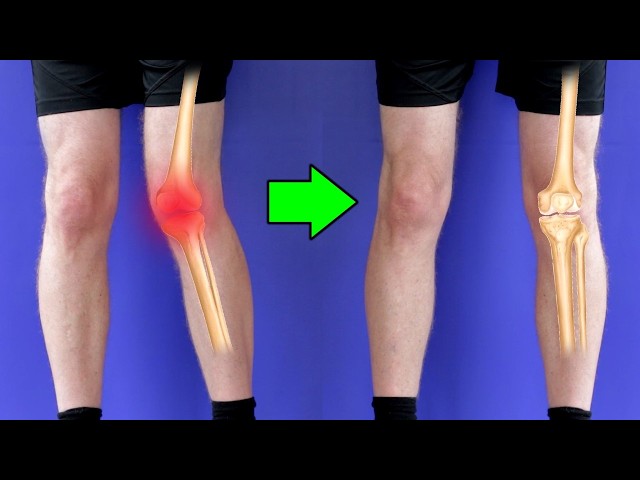 Overcoming Dynamic Knee Valgus For Permanent Knee Pain Relief