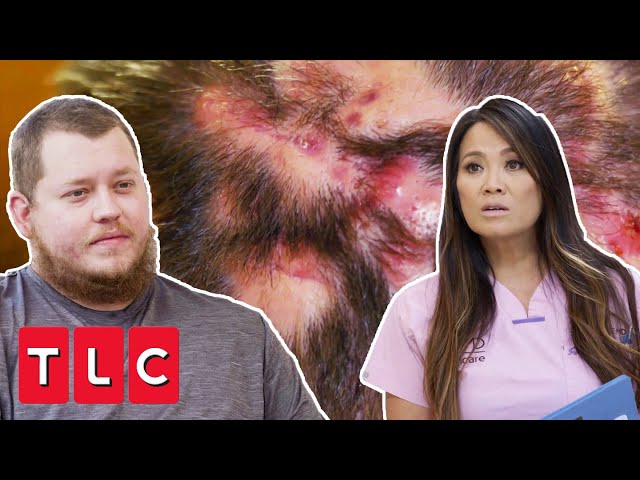 Dr Lee Helps Father That’s Been Suffering With Misdiagnosis For 3 Years | Dr Pimple Popper: Pop Ups