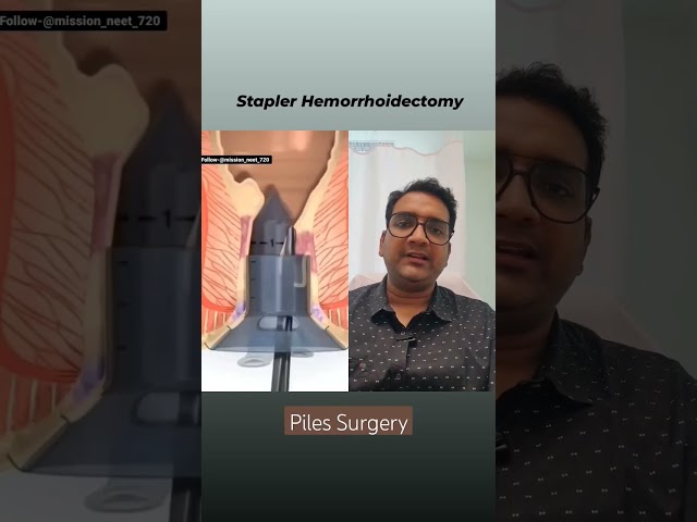 Piles Surgery I Stapler and Laser Hemorrhoid(Piles) Surgery in Delhi Noida