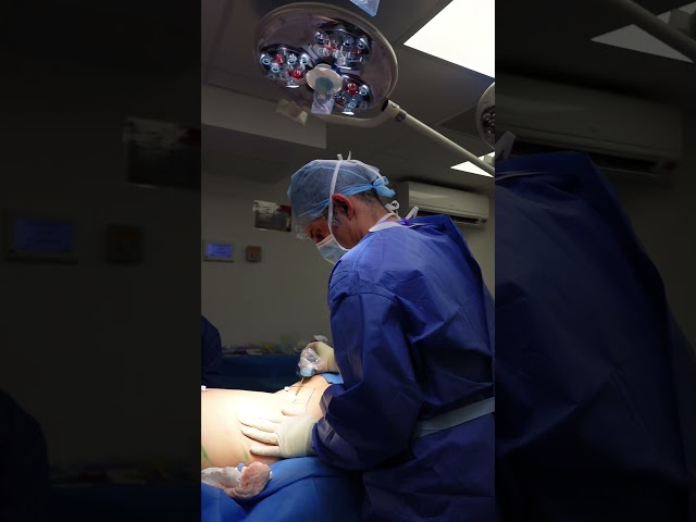 Am I suitable for BBL surgery? 💉🥼 #london #plasticsurgery #bbl
