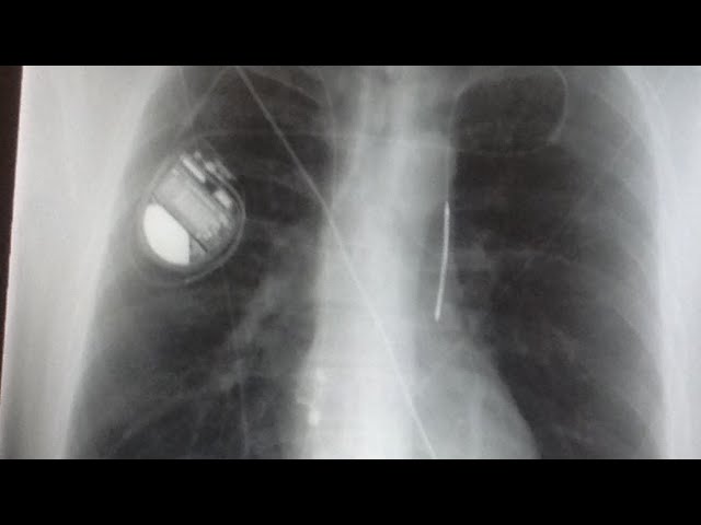 Boston Scientific info on airport security and implanted pacemakers and defibrillators