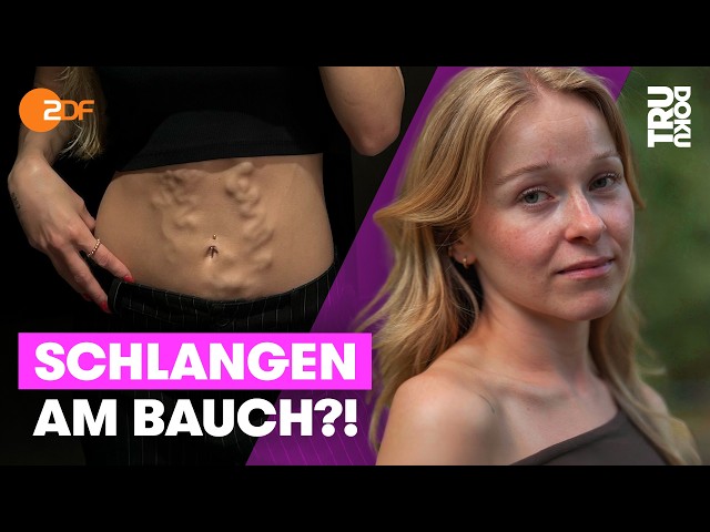Thrombose mit 19: „Ich wurde ständig angestarrt“ | TRU DOKU
